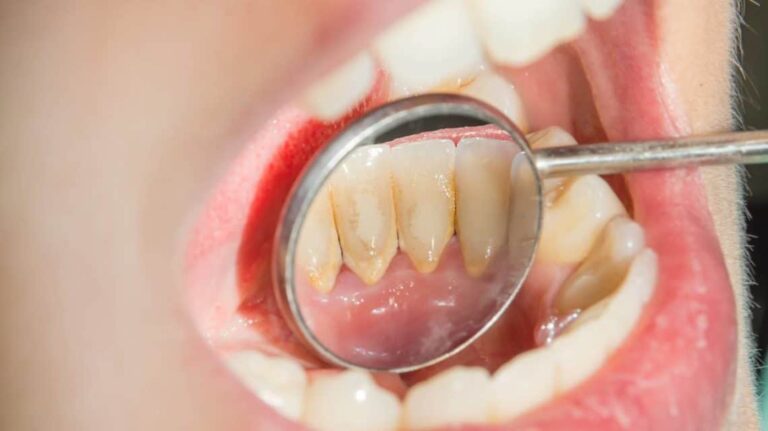 How To Remove Tartar And Plaque From Your Teeth Without A Dentist